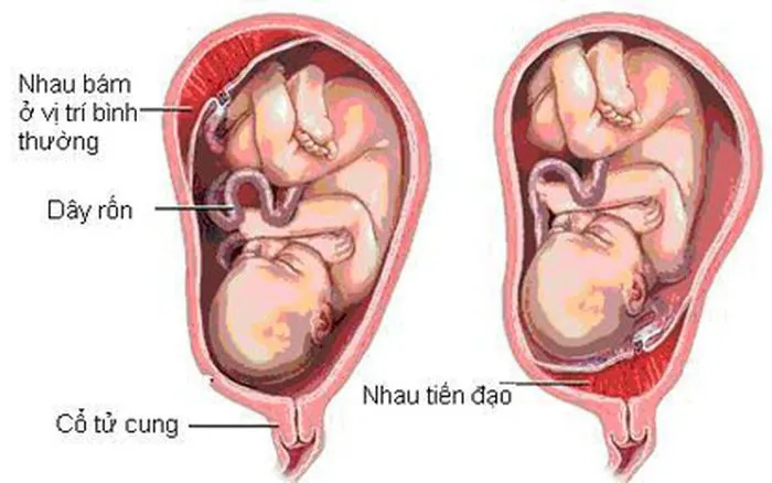 Đi tiểu ra máu khi mang thai tháng cuối